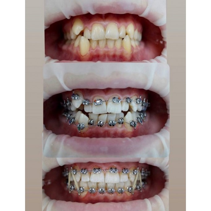 Як обрати стоматолога для імплантації зубів