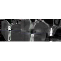 КІСТКОВА ПЛАСТИКА КІСТКОВА ПЛАСТИКА