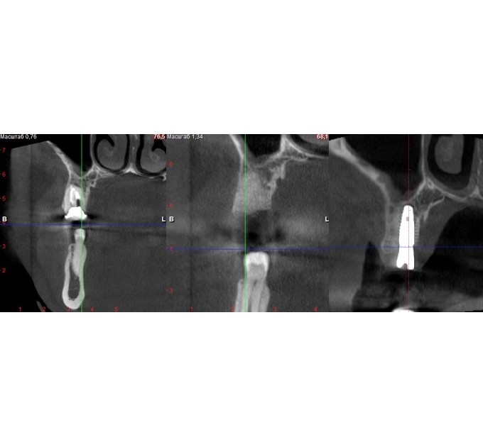 КІСТКОВА ПЛАСТИКА