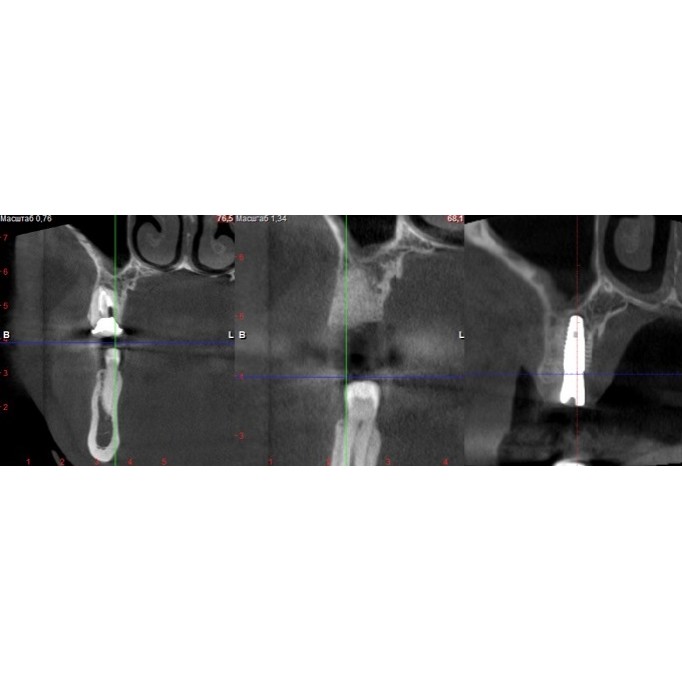 Вступ до імплантації зубів