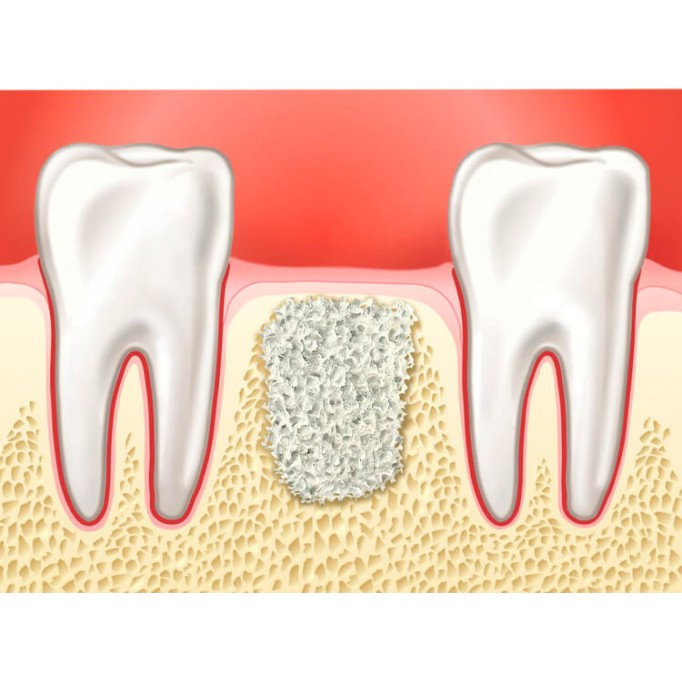 Види і технології проведення кісткової пластики