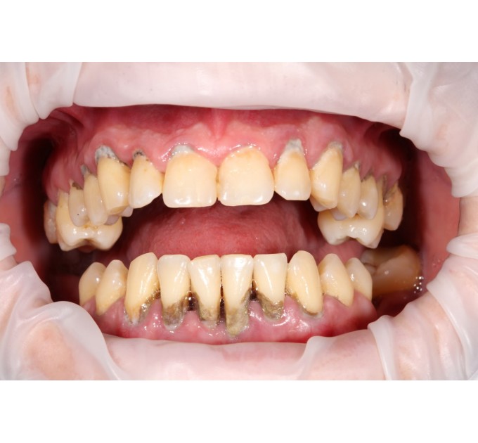 ІМПЛАНТАЦІЯ ЗУБІВ