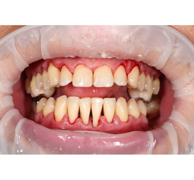 ІМПЛАНТАЦІЯ ЗУБІВ