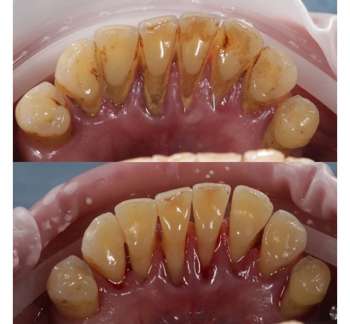 ІМПЛАНТАЦІЯ ЗУБІВ