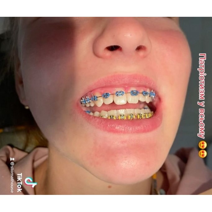 Протипоказання до установки брекетів