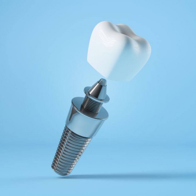 Технології в імплантації зубів: Сучасні досягнення