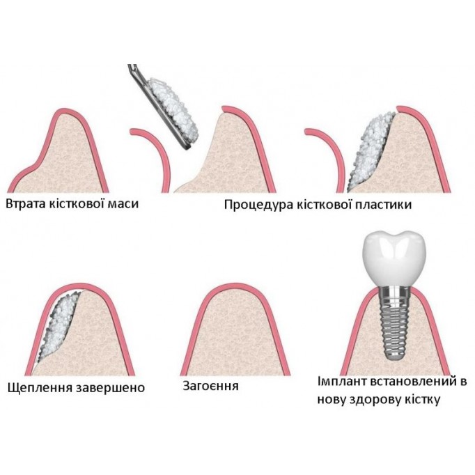 Що таке кісткова пластика в стоматології?