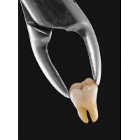 ВИДАЛЕННЯ ЗУБА ВИДАЛЕННЯ ЗУБА