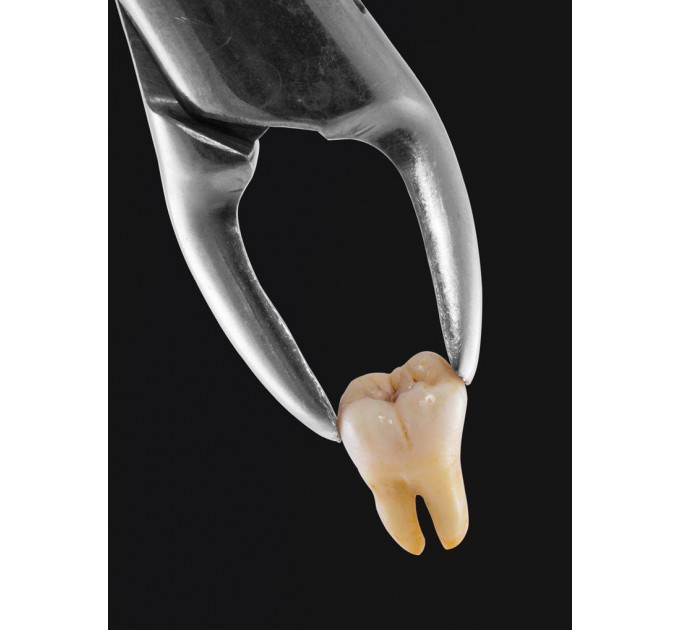 EXTRACTION OF A TOOTH