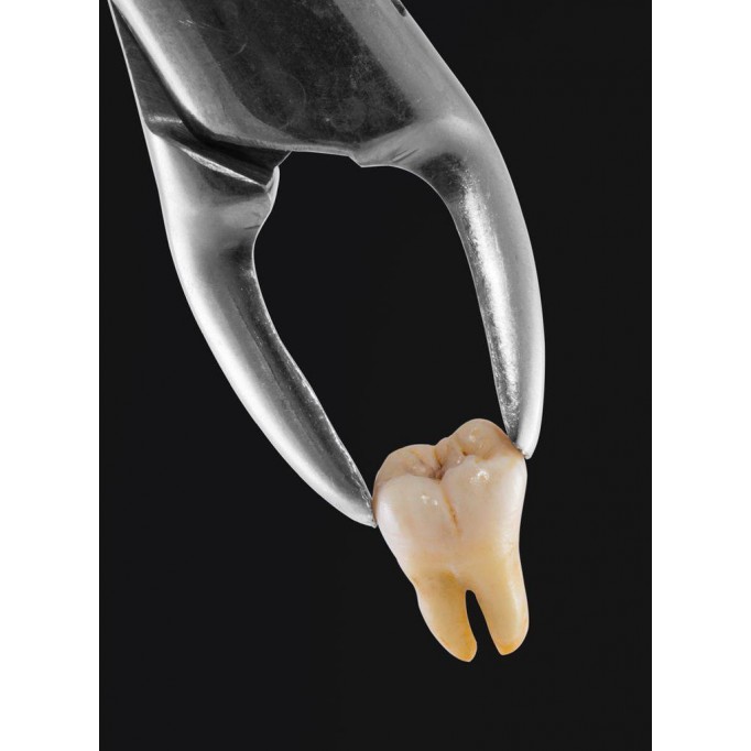 Видалення зуба - Що не можна?