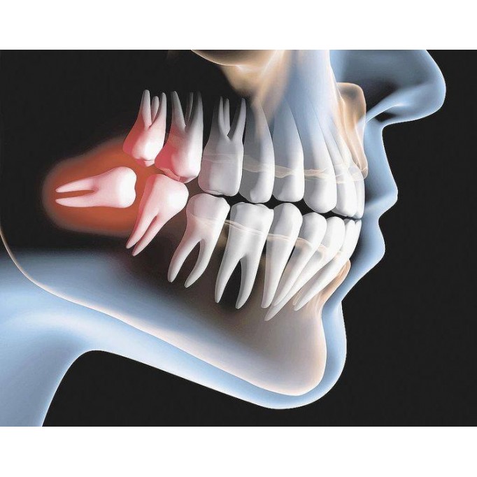 Видалення зуба мудрості