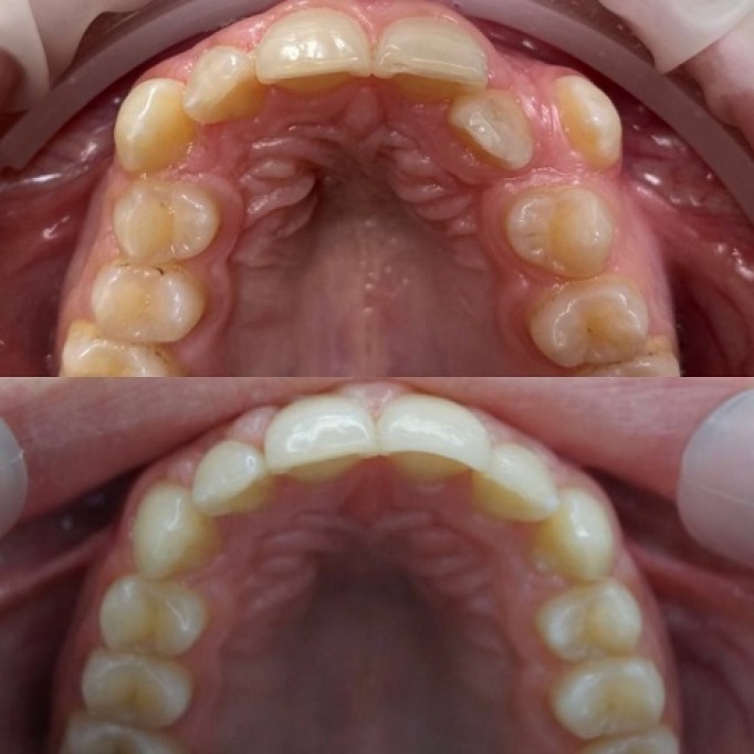Встановлення Брекетів це модно!