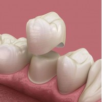 ЗНІМНЕ-НЕЗНІМНЕ ПРОТЕЗУВАННЯ (ОРТОПЕДІЯ)