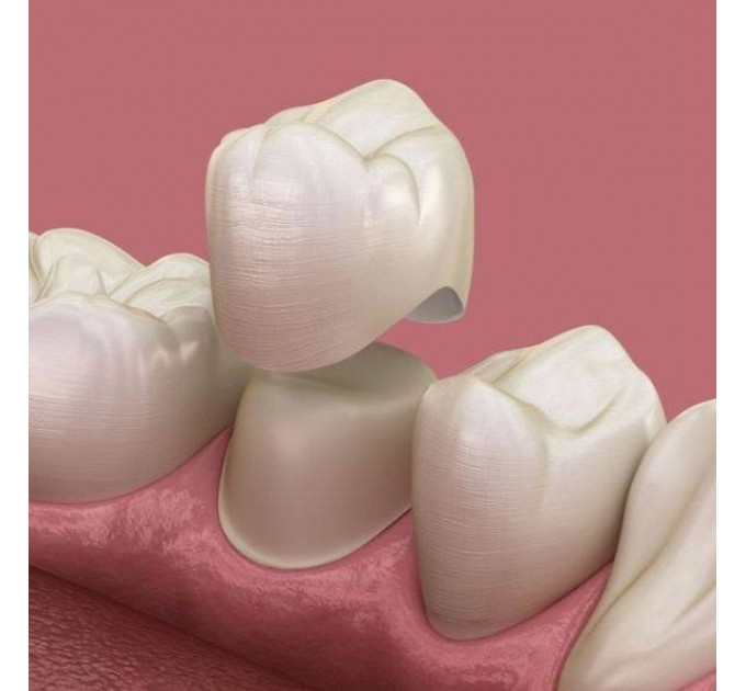 ЗНІМНЕ-НЕЗНІМНЕ ПРОТЕЗУВАННЯ (ОРТОПЕДІЯ)
