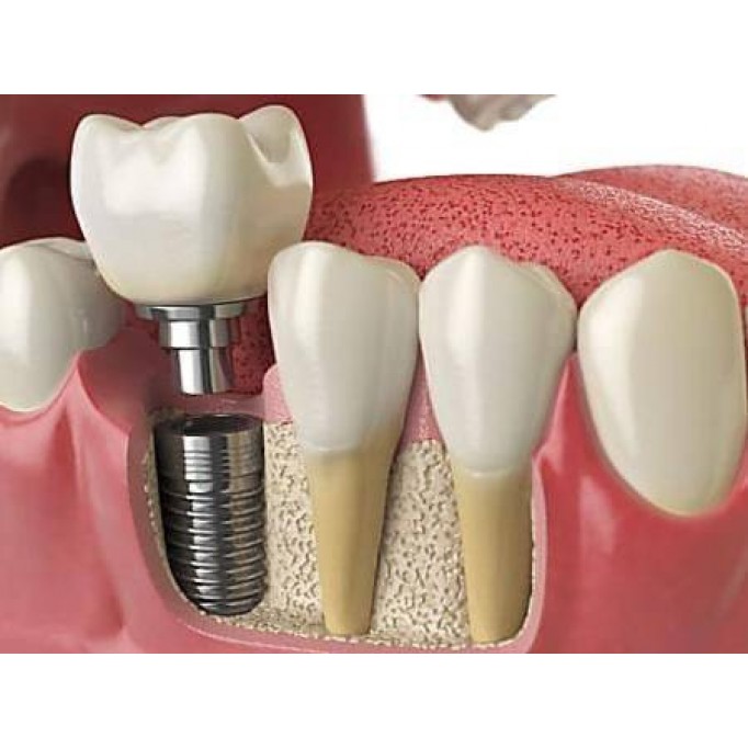 Чому не можна відкладати імплантацію зубів?