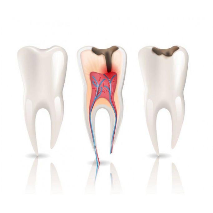 Видалення зуба - причини