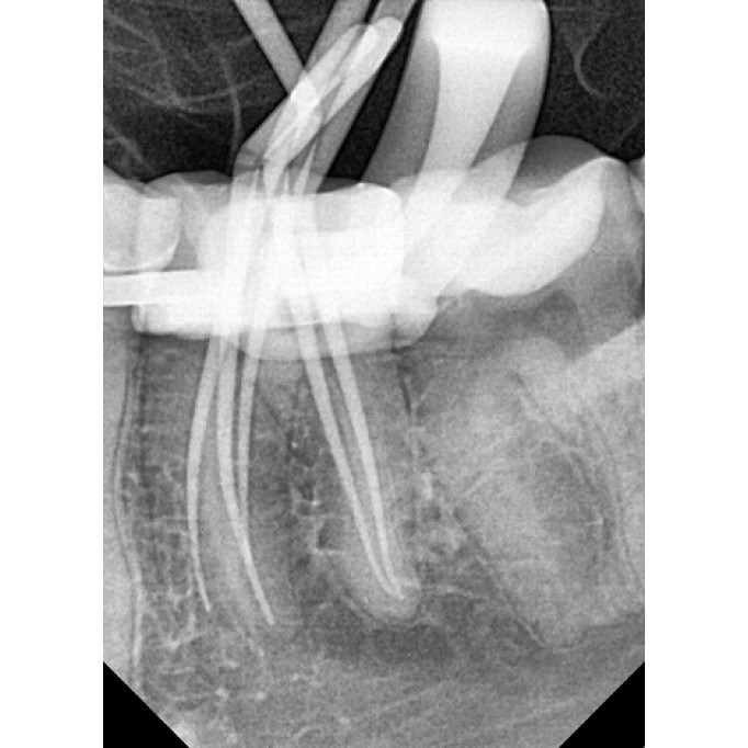 Ендодонтія - Лікування зубів під мікроскопом в Луцьку, стоматолог луцьк, стоматологія луцьк