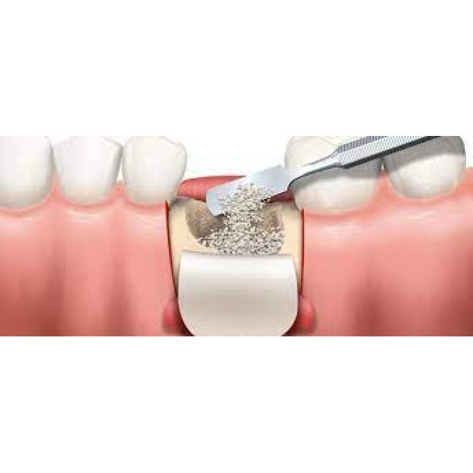 Рекомендації після кісткової пластики
