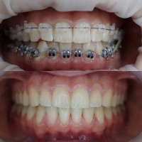 ВСТАНОВЛЕННЯ БРЕКЕТІВ