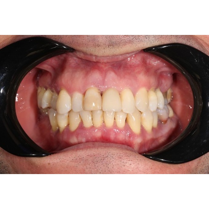 Післяопераційний догляд за зубними імплантатами: Як уникнути ускладнень